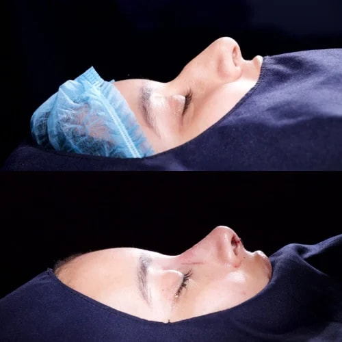 Resultado de Rinoplastia Estética 1