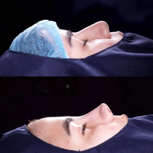 Resultado de Rinoplastia Estética 2