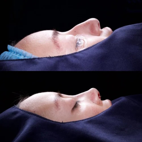 Resultado de Rinoplastia Estética 3