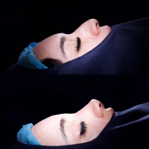 Resultado de Rinoplastia Estética 4