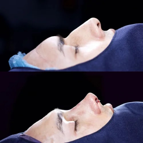 Resultado de Rinoplastia Estética 5