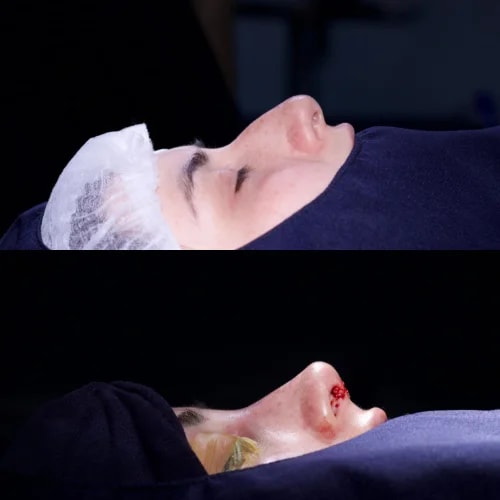 Resultado de Rinoplastia Funcional 1