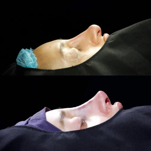 Resultado de Rinoplastia Funcional 2