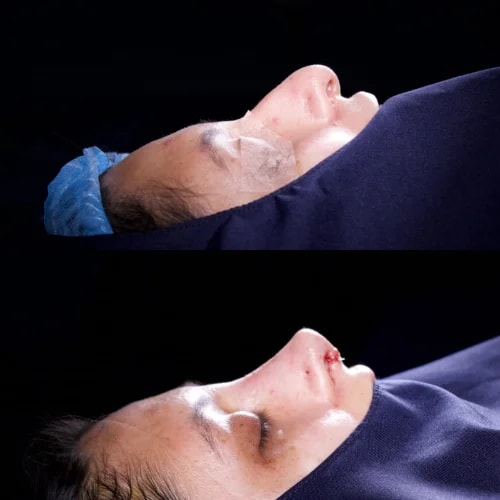 Resultado de Rinoplastia Funcional 3