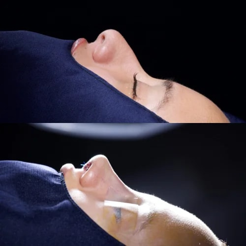 Resultado de Rinoplastia Funcional 4