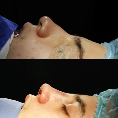 Resultado de Rinoplastia Funcional 5