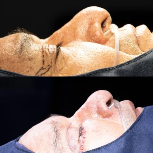 Resultado de Blefaroplastia 1