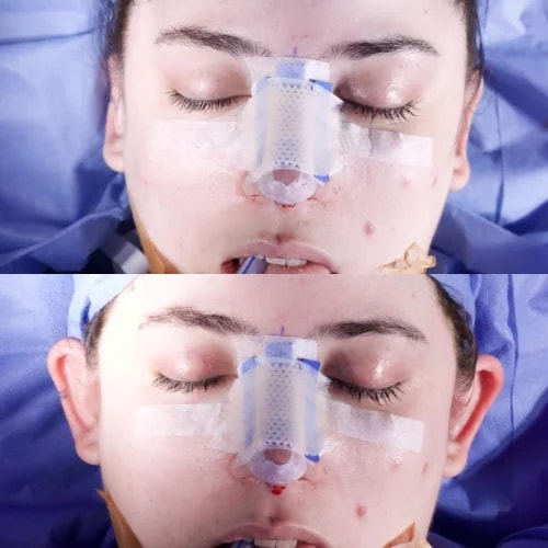 Resultado de Otoplastia 2