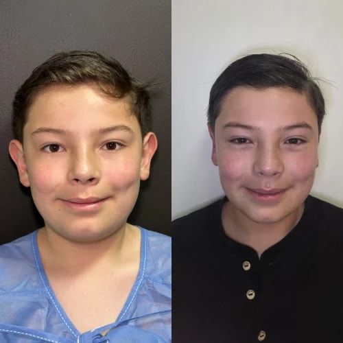 Resultado de Otoplastia 3