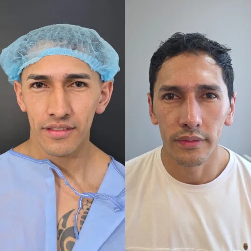 Resultado de Otoplastia 4